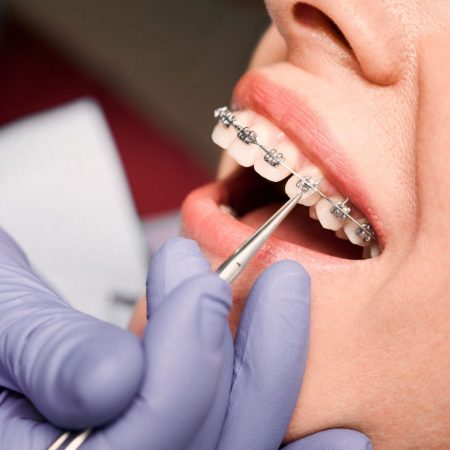 Close up of dentist hand in serial glove putting elastic rubber band on patient brackets. Woman with wired metal braces on teeth receiving orthodontic treatment in dental clinic. Concept of dentistry.